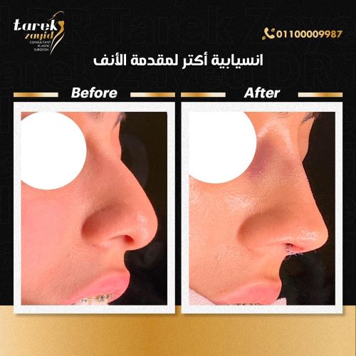افضل دكتور تجميل انف في مصر 2026